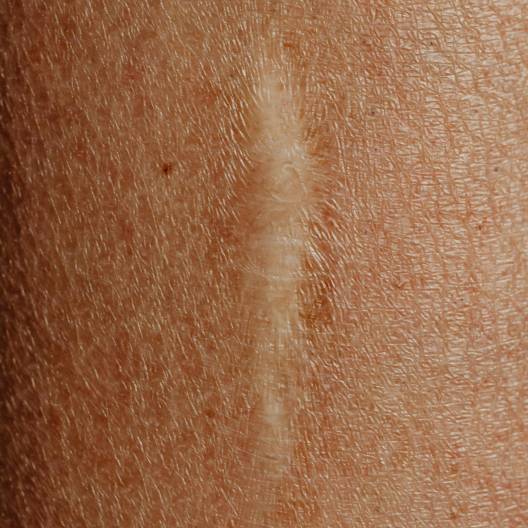 Scar Tissue